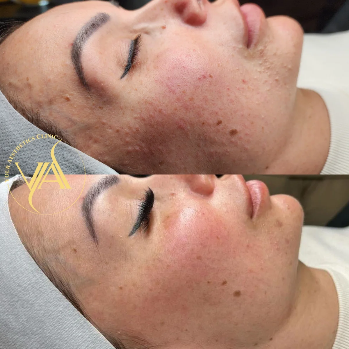 Advanced BioRePeelCl3 Chemical Peel